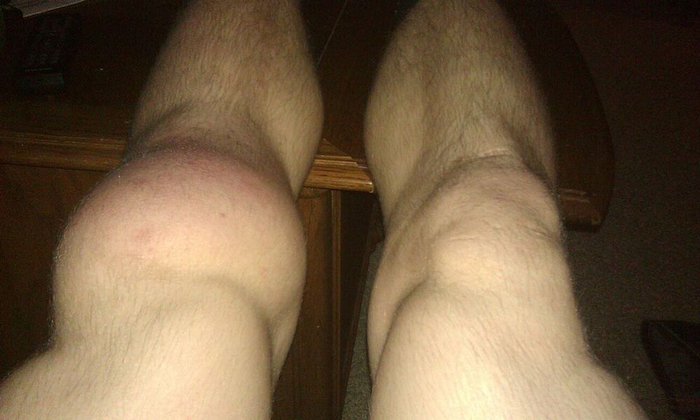 koleno před léčbou Osteflexem
