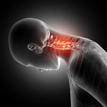 Cervikální osteochondrosis